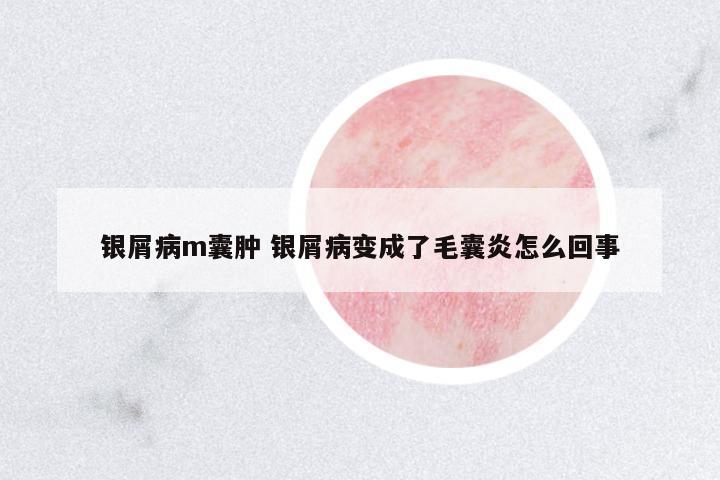 銀屑病m囊腫 銀屑病變成了毛囊炎怎么回事