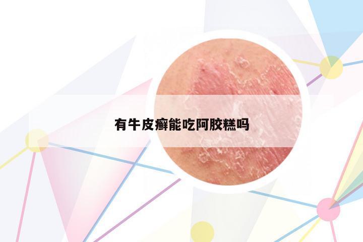 有牛皮癬能吃阿膠糕嗎