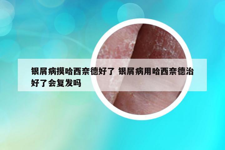 銀屑病摸哈西奈德好了 銀屑病用哈西奈德治好了會(huì)復(fù)發(fā)嗎