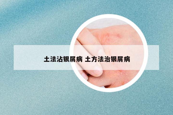 土法沾銀屑病 土方法治銀屑病