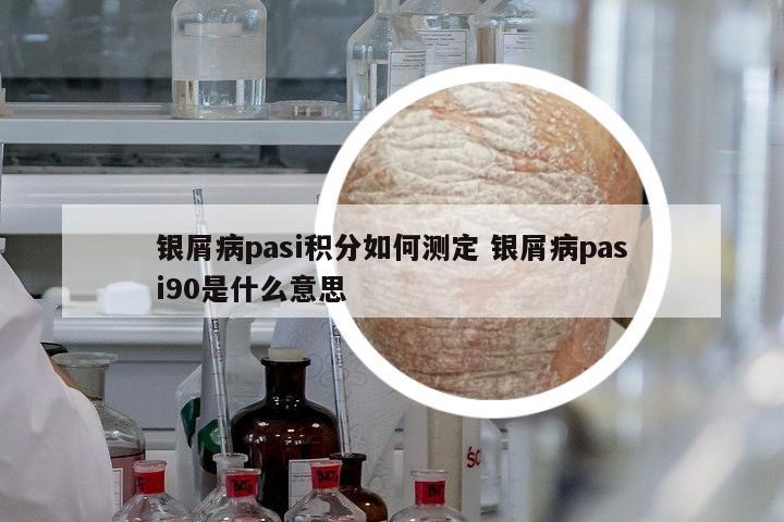 銀屑病pasi積分如何測定 銀屑病pasi90是什么意思