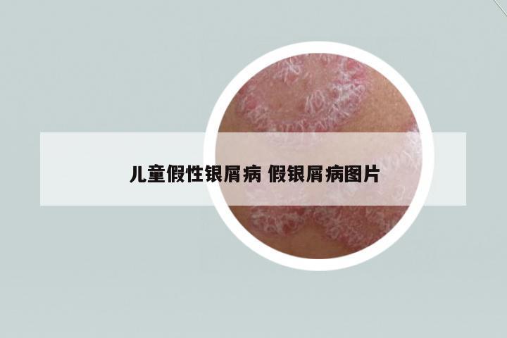 兒童假性銀屑病 假銀屑病圖片