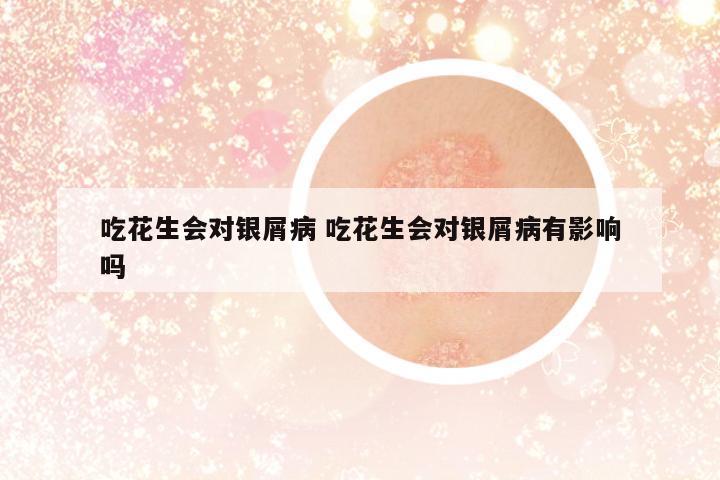 吃花生會對銀屑病 吃花生會對銀屑病有影響嗎