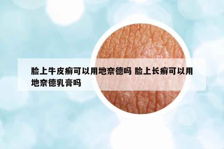 臉上牛皮癬可以用地奈德嗎 臉上長癬可以用地奈德乳膏嗎