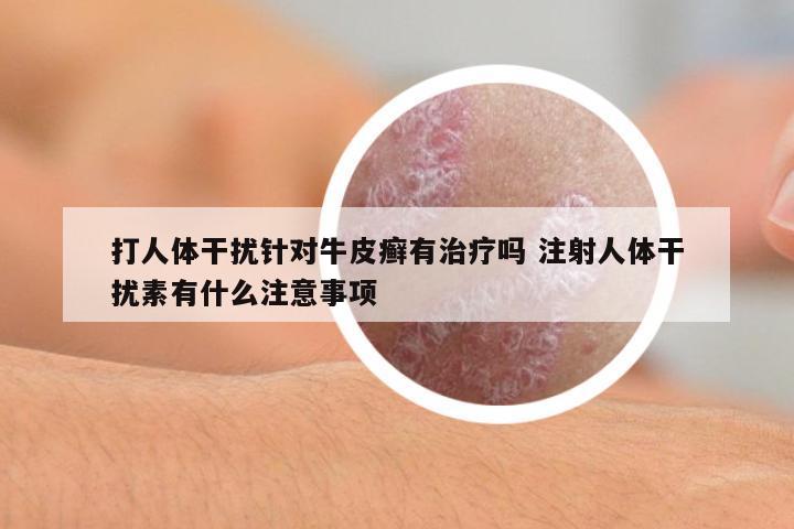 打人體干擾針對牛皮癬有治療嗎 注射人體干擾素有什么注意事項