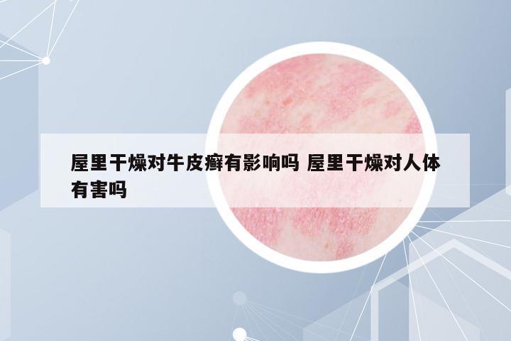 屋里干燥對(duì)牛皮癬有影響嗎 屋里干燥對(duì)人體有害嗎