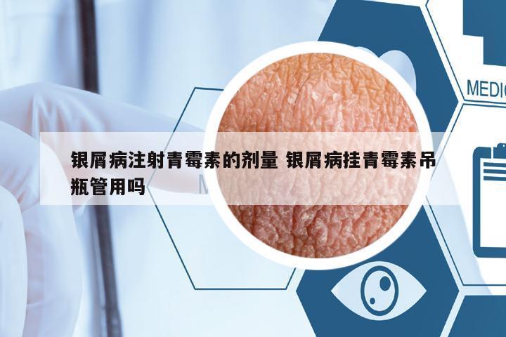 銀屑病注射青霉素的劑量 銀屑病掛青霉素吊瓶管用嗎