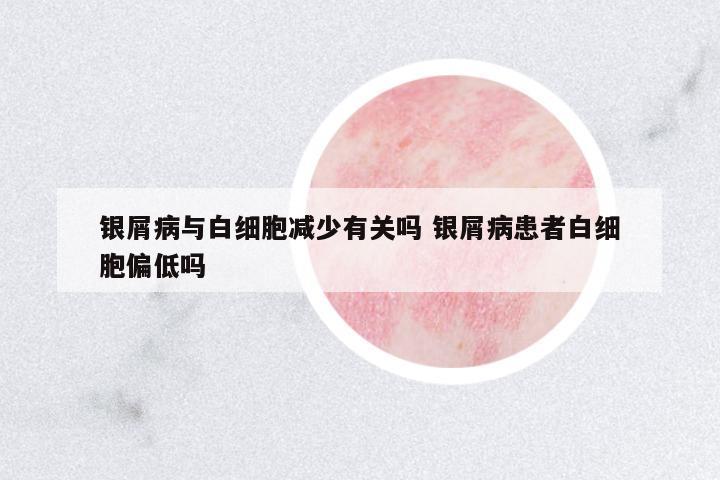 銀屑病與白細胞減少有關嗎 銀屑病患者白細胞偏低嗎