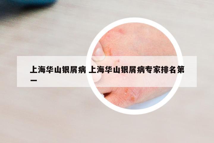 上海華山銀屑病 上海華山銀屑病專家排名第一