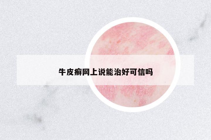 牛皮癬網上說能治好可信嗎