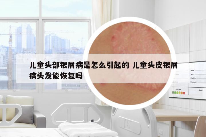 兒童頭部銀屑病是怎么引起的 兒童頭皮銀屑病頭發(fā)能恢復(fù)嗎