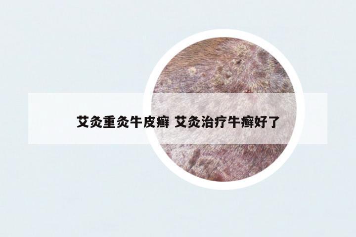 艾灸重灸牛皮癬 艾灸治療牛癬好了