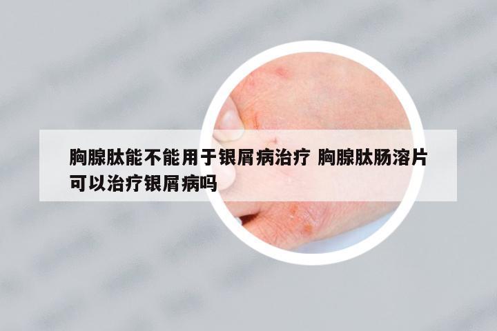 胸腺肽能不能用于銀屑病治療 胸腺肽腸溶片可以治療銀屑病嗎
