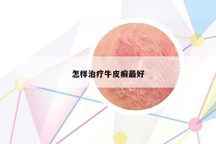 怎樣治療牛皮癬最好