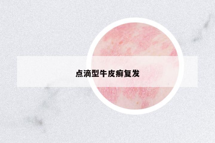點滴型牛皮癬復發(fā)