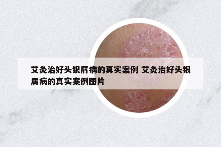 艾灸治好頭銀屑病的真實(shí)案例 艾灸治好頭銀屑病的真實(shí)案例圖片