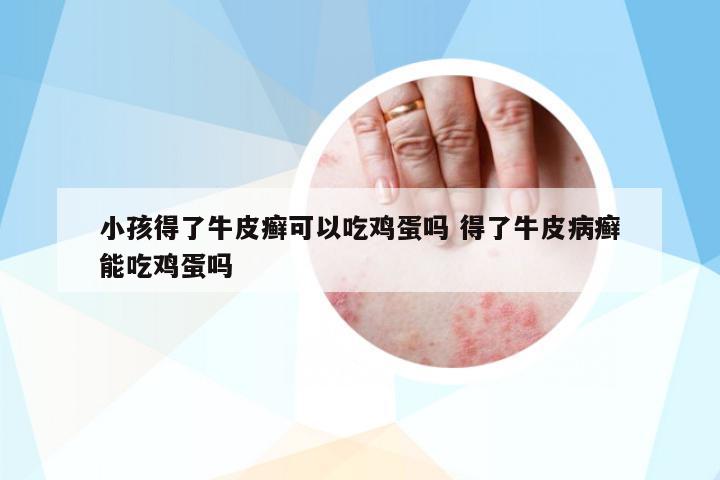 小孩得了牛皮癬可以吃雞蛋嗎 得了牛皮病癬能吃雞蛋嗎