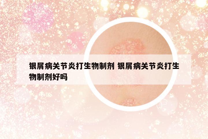 銀屑病關(guān)節(jié)炎打生物制劑 銀屑病關(guān)節(jié)炎打生物制劑好嗎