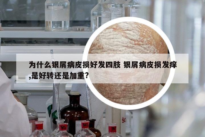 為什么銀屑病皮損好發(fā)四肢 銀屑病皮損發(fā)癢,是好轉(zhuǎn)還是加重?