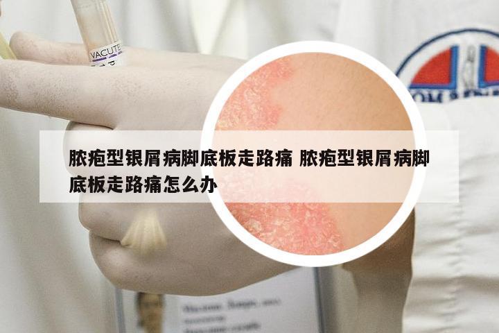 膿皰型銀屑病腳底板走路痛 膿皰型銀屑病腳底板走路痛怎么辦