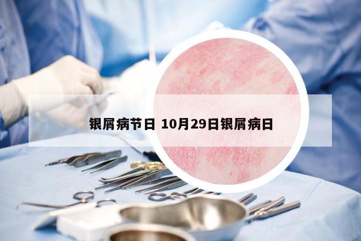 銀屑病節(jié)日 10月29日銀屑病日