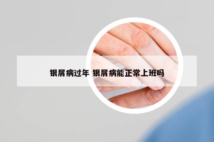 銀屑病過年 銀屑病能正常上班嗎