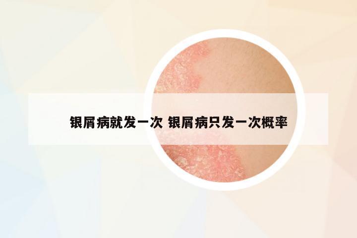 銀屑病就發(fā)一次 銀屑病只發(fā)一次概率