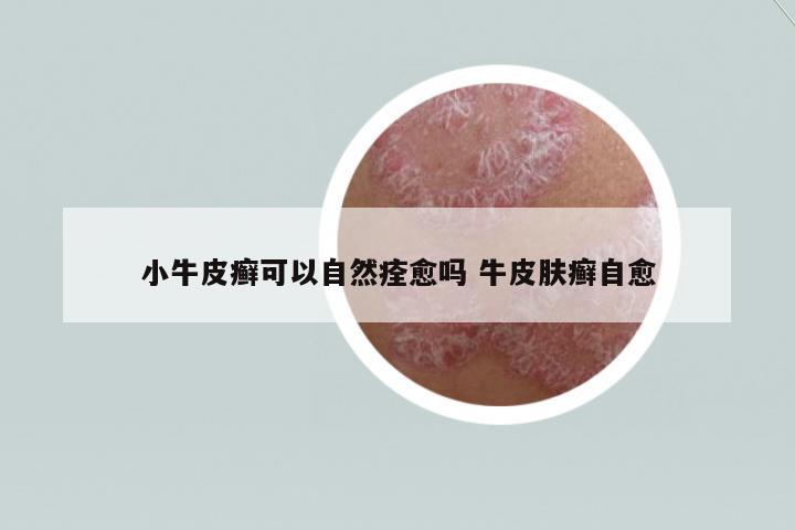 小牛皮癬可以自然痊愈嗎 牛皮膚癬自愈
