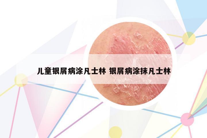 兒童銀屑病涂凡士林 銀屑病涂抹凡士林