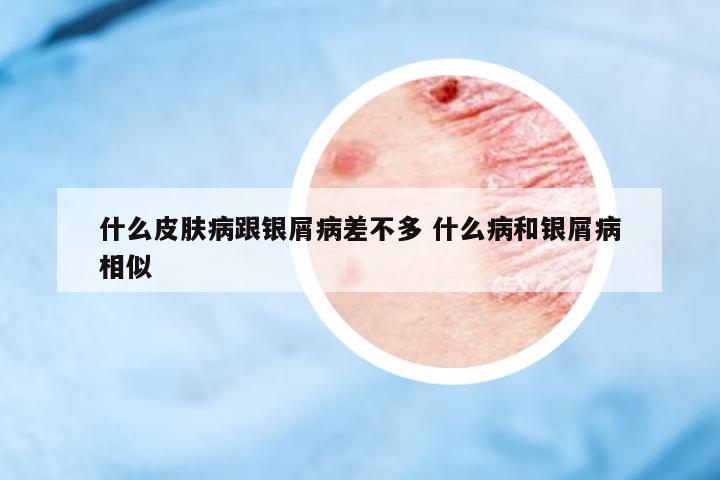 什么皮膚病跟銀屑病差不多 什么病和銀屑病相似