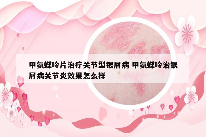 甲氨蝶呤片治療關(guān)節(jié)型銀屑病 甲氨蝶呤治銀屑病關(guān)節(jié)炎效果怎么樣