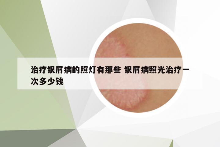 治療銀屑病的照燈有那些 銀屑病照光治療一次多少錢