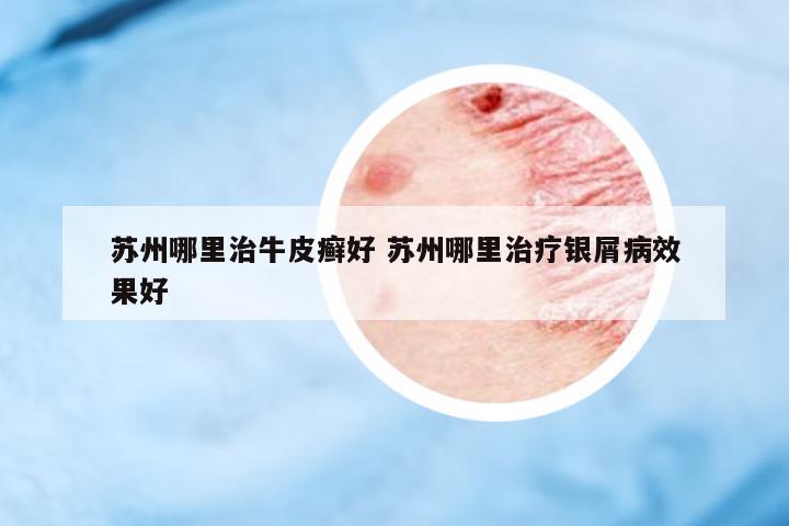 蘇州哪里治牛皮癬好 蘇州哪里治療銀屑病效果好