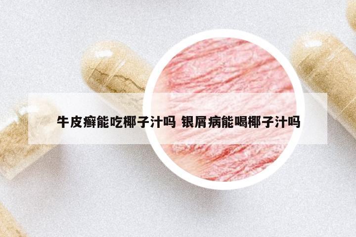 牛皮癬能吃椰子汁嗎 銀屑病能喝椰子汁嗎
