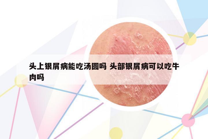 頭上銀屑病能吃湯圓嗎 頭部銀屑病可以吃牛肉嗎