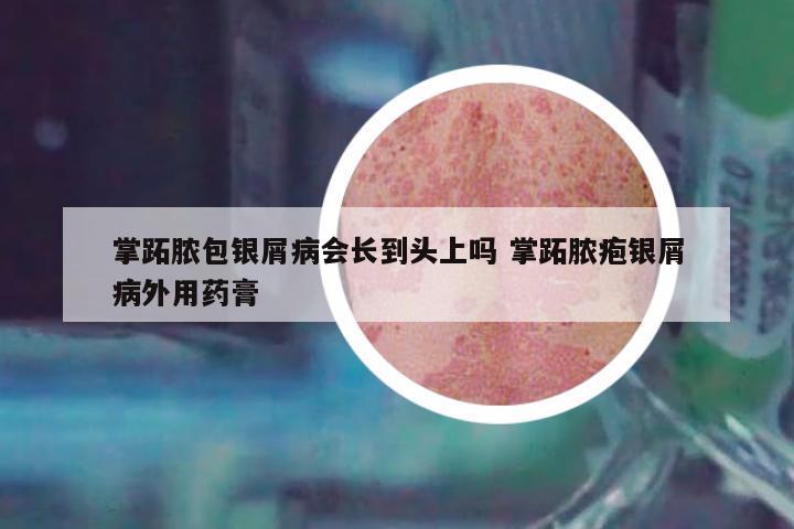 掌跖膿包銀屑病會(huì)長(zhǎng)到頭上嗎 掌跖膿皰銀屑病外用藥膏