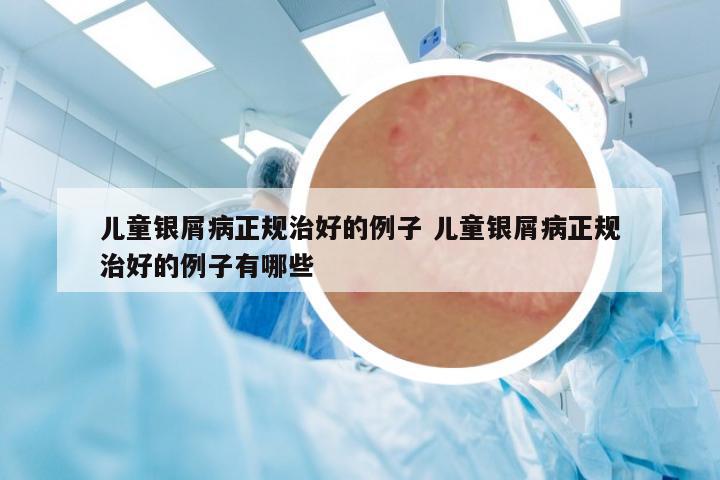 兒童銀屑病正規(guī)治好的例子 兒童銀屑病正規(guī)治好的例子有哪些