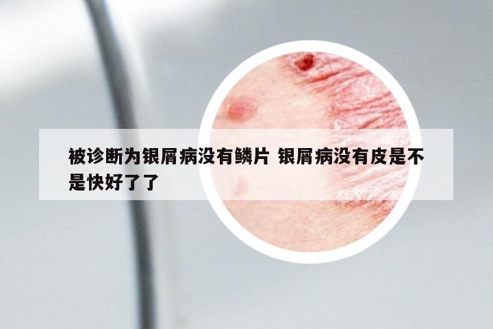 被診斷為銀屑病沒有鱗片 銀屑病沒有皮是不是快好了了
