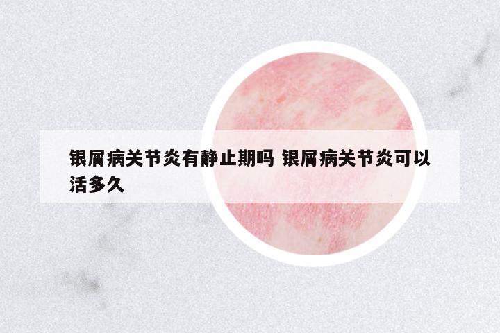 銀屑病關(guān)節(jié)炎有靜止期嗎 銀屑病關(guān)節(jié)炎可以活多久