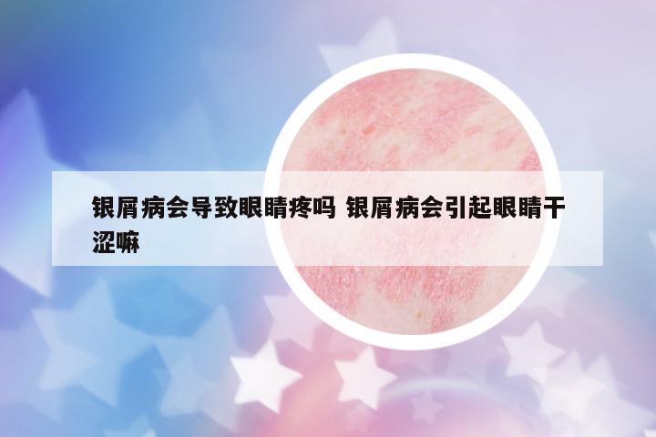銀屑病會導致眼睛疼嗎 銀屑病會引起眼睛干澀嘛