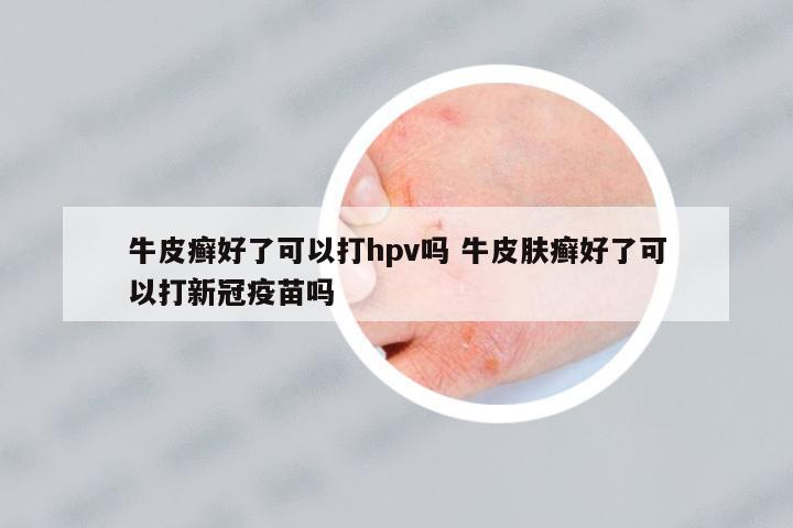 牛皮癬好了可以打hpv嗎 牛皮膚癬好了可以打新冠疫苗嗎