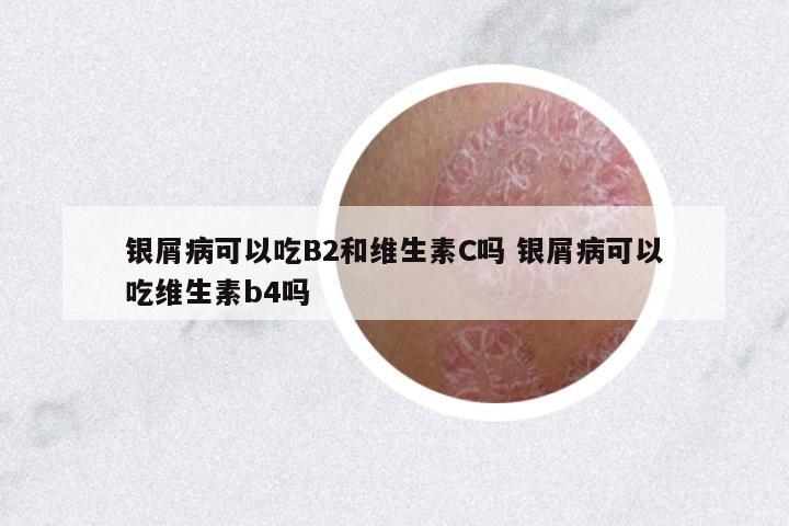 銀屑病可以吃B2和維生素C嗎 銀屑病可以吃維生素b4嗎