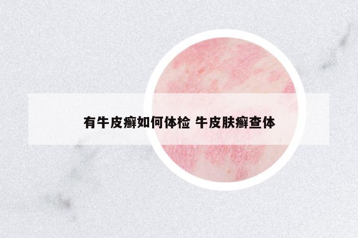 有牛皮癬如何體檢 牛皮膚癬查體