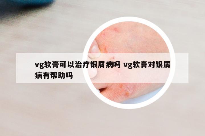 vg軟膏可以治療銀屑病嗎 vg軟膏對(duì)銀屑病有幫助嗎