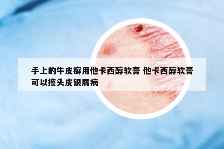 手上的牛皮癬用他卡西醇軟膏 他卡西醇軟膏可以擦頭皮銀屑病
