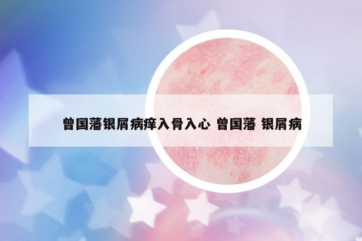 曾國(guó)藩銀屑病癢入骨入心 曾國(guó)藩 銀屑病