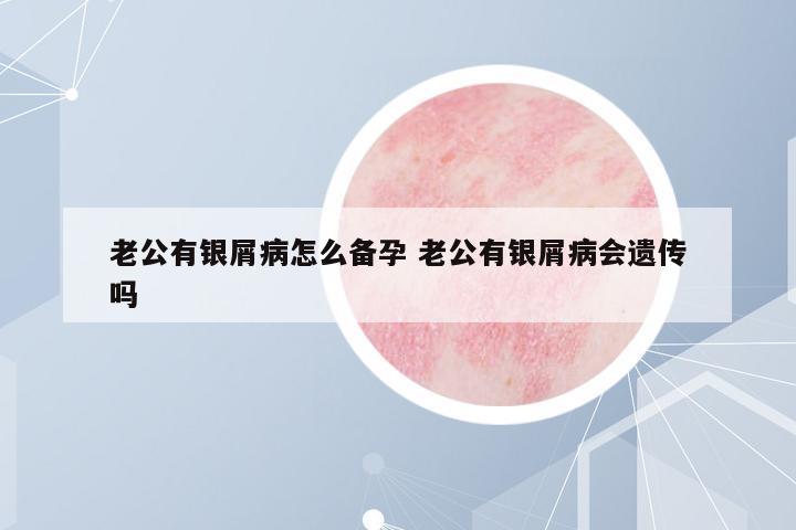 老公有銀屑病怎么備孕 老公有銀屑病會(huì)遺傳嗎