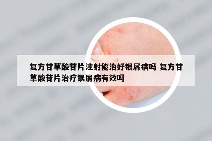 復方甘草酸苷片注射能治好銀屑病嗎 復方甘草酸苷片治療銀屑病有效嗎