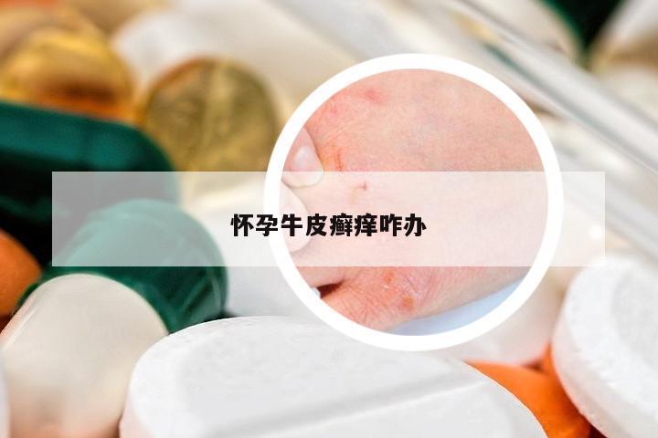 懷孕牛皮癬癢咋辦