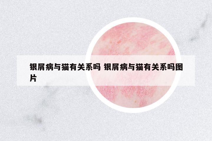 銀屑病與貓有關(guān)系嗎 銀屑病與貓有關(guān)系嗎圖片